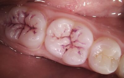 Preventing decay with fissure sealants