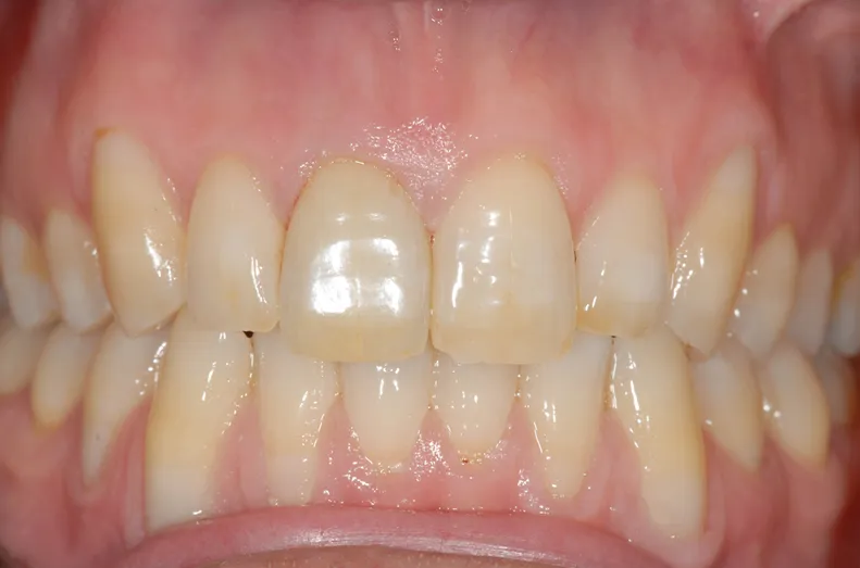 After Dental implant