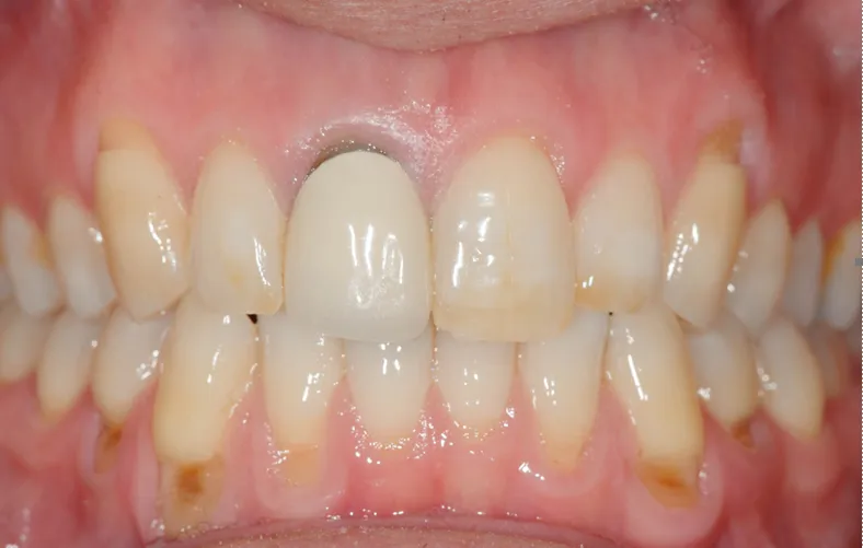 Before Dental implant Before Dental implant