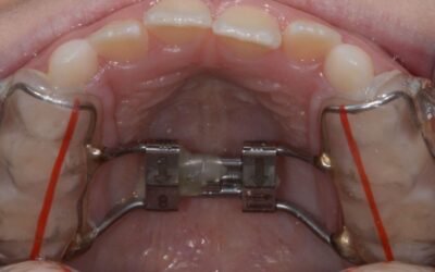 Does My Child Need an Expander?