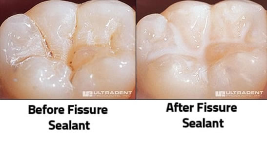 Before and After Fissure Sealant