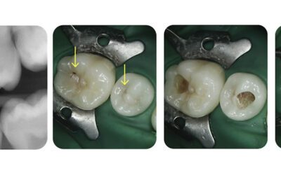 A recent case study on Dental Decay