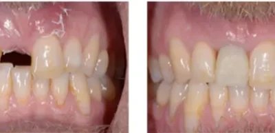 A Recent Case Study on Dental Implants